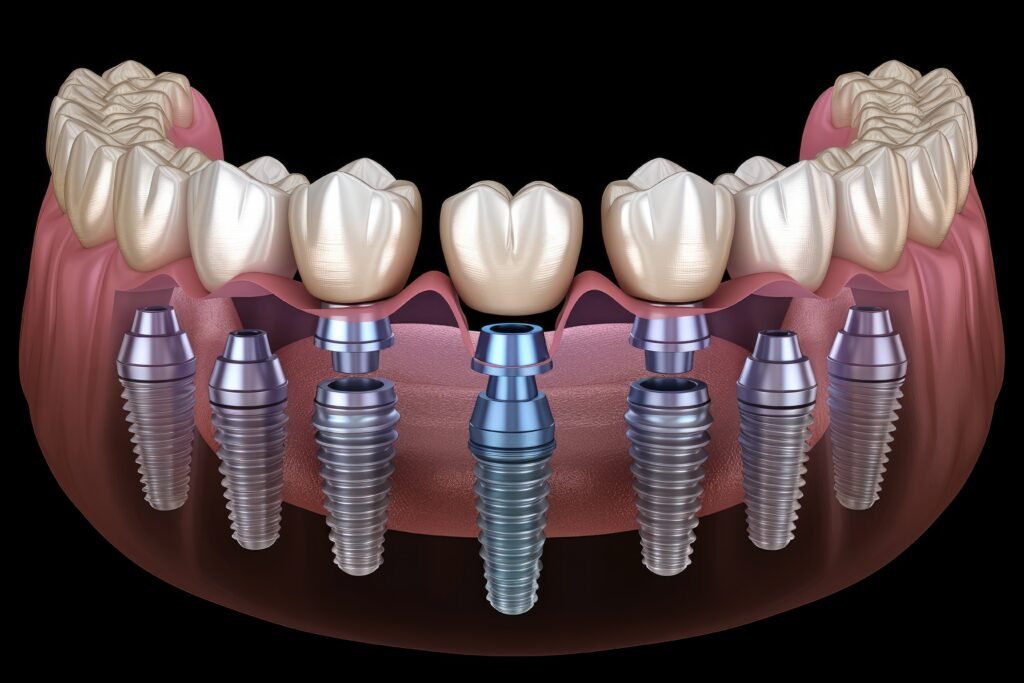All-on-8 dental implants in Istanbul at Taksim Clinic