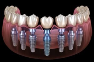 All-on-8 dental implants in Istanbul at Taksim Clinic
