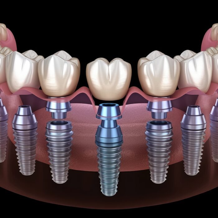 All-on-8 dental implants in Istanbul at Taksim Clinic